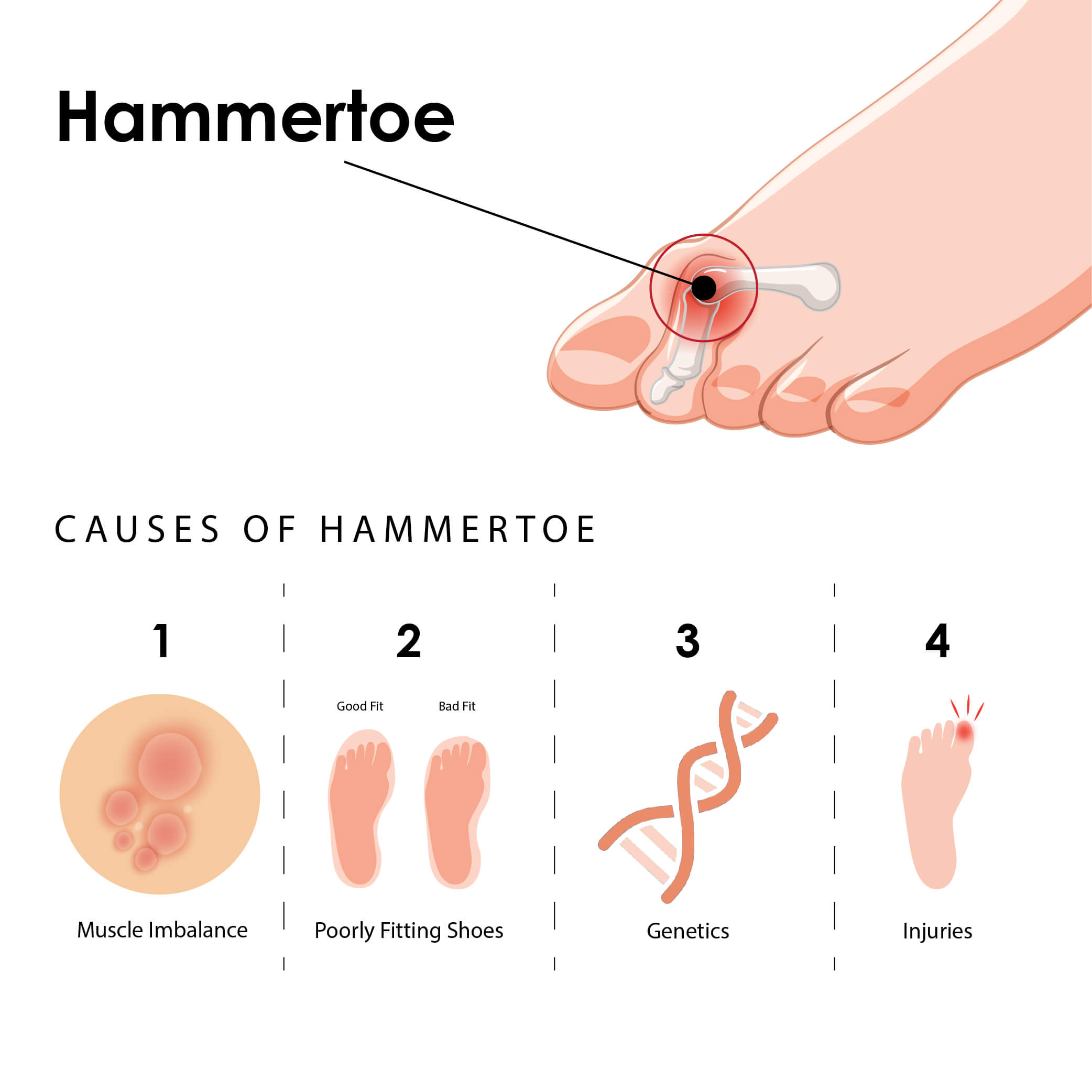 Hammertoe causes