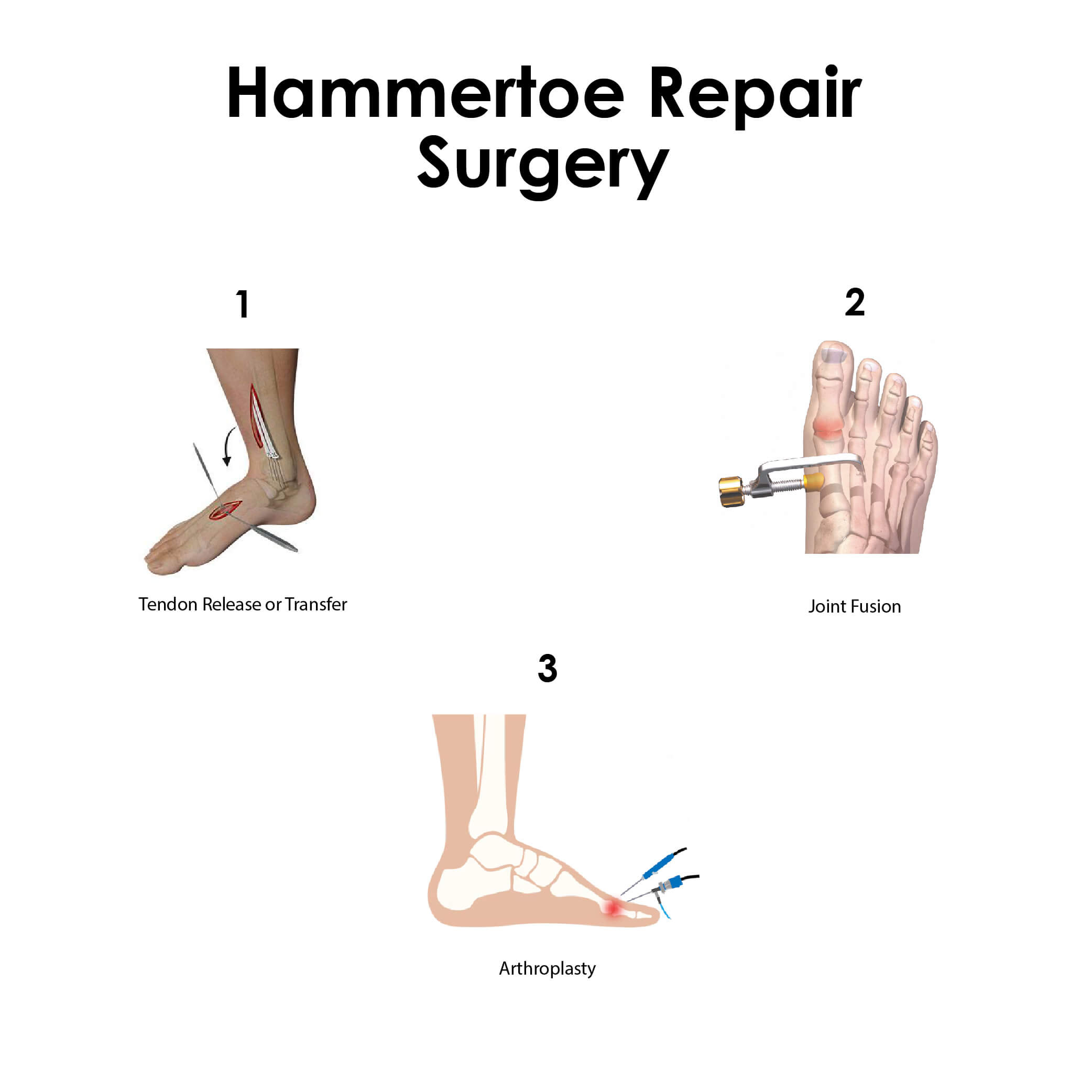 Hammertoe repair