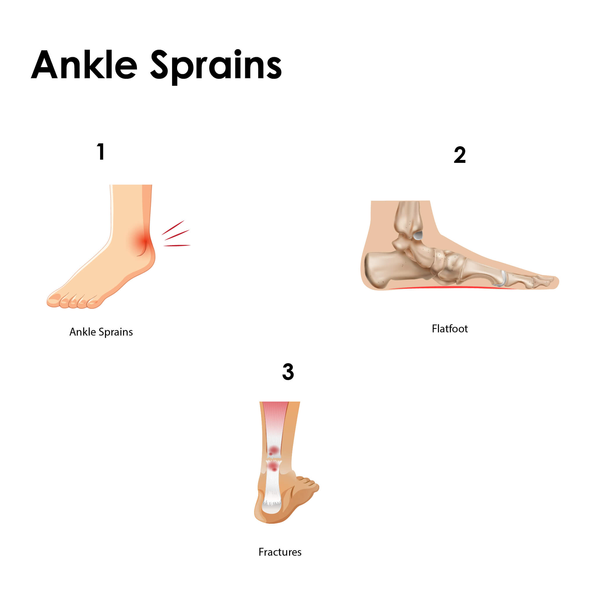 Ankle Sprains