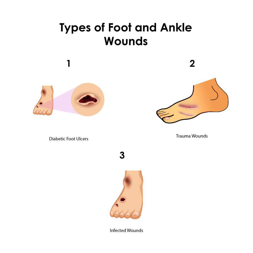 Foot and Ankle Wounds