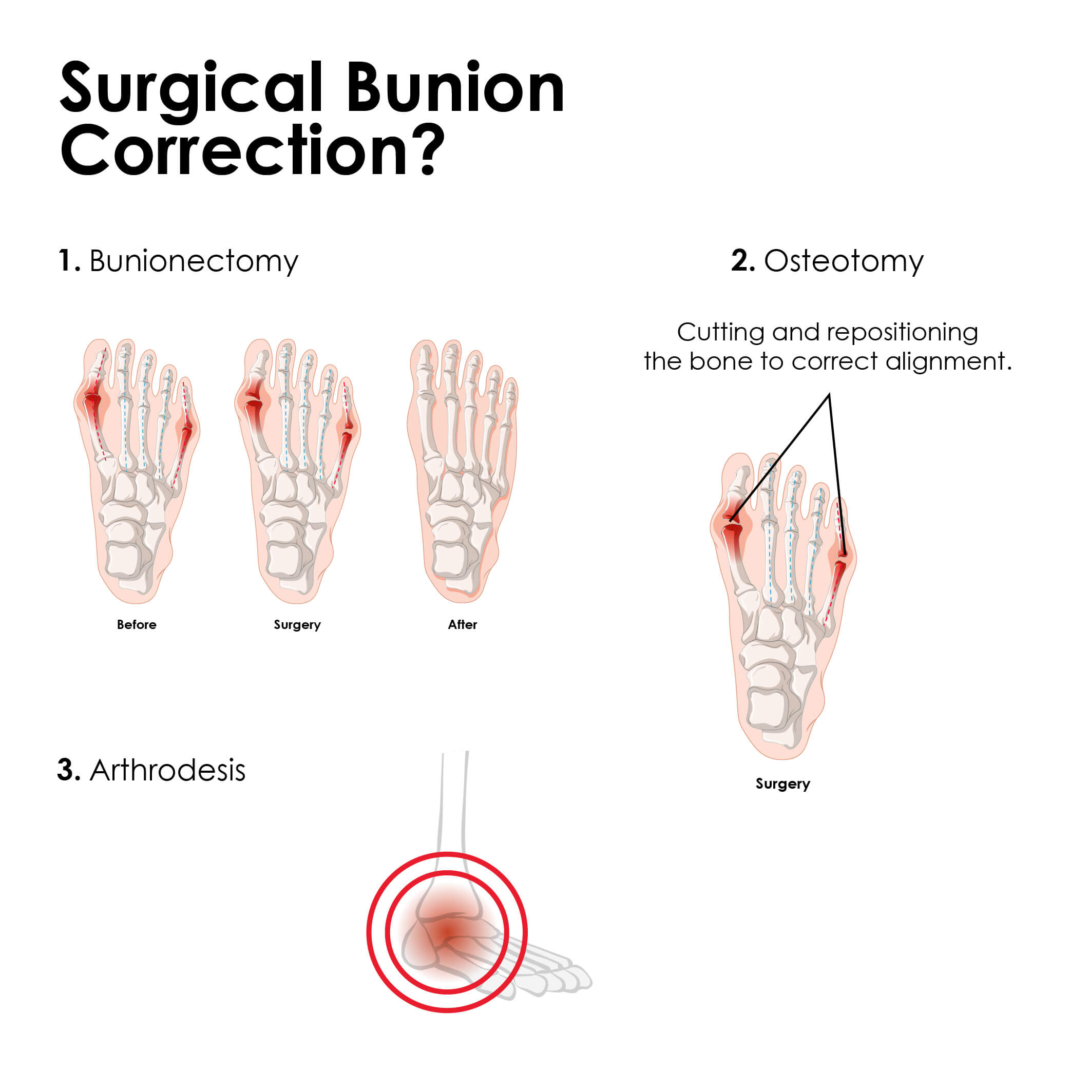 Surgical Bunion Correction